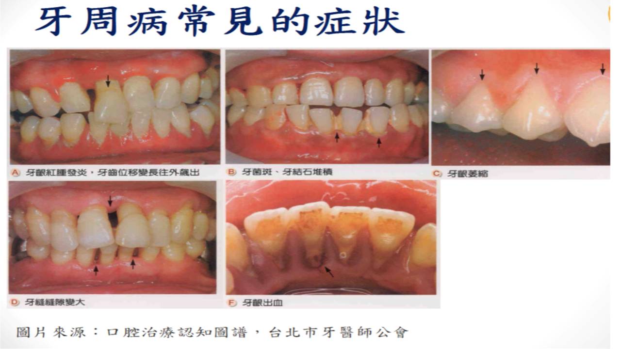 牙周病常見的症狀